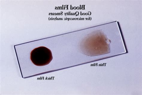 thick and thin smear test|thick and thin smear preparation.